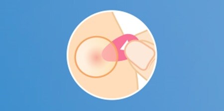 PASO 2 - Aplicar el parche para granos con la pestaña roja hacia la piel
